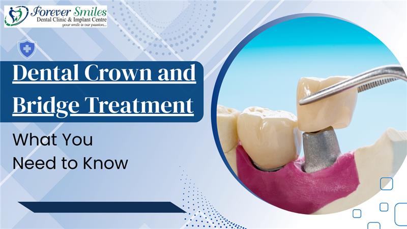 Dental crown and bridge treatment
