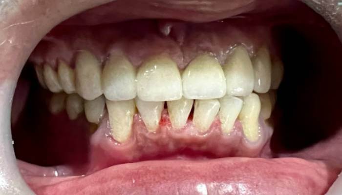Patient 3 after treatment